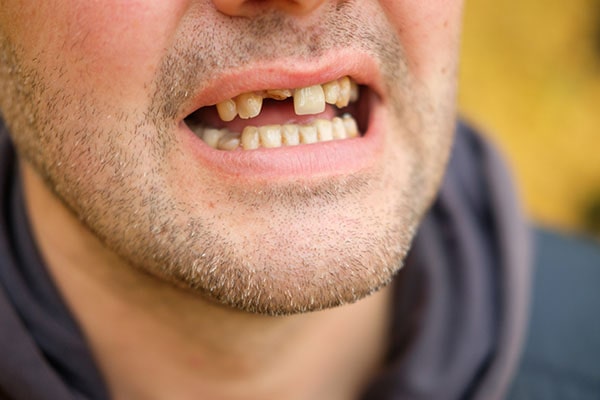 Broken Tooth