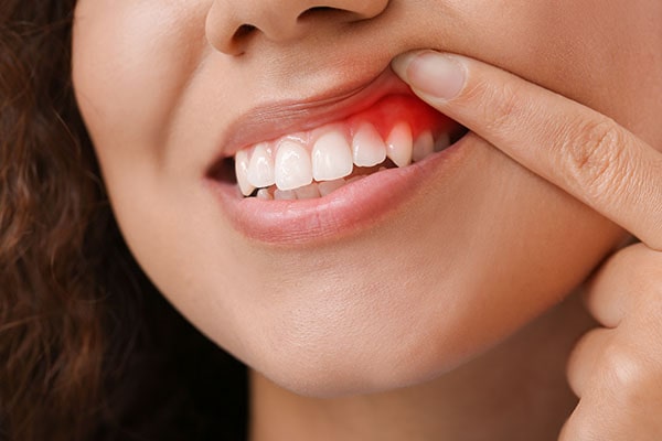 Swollen Gums
